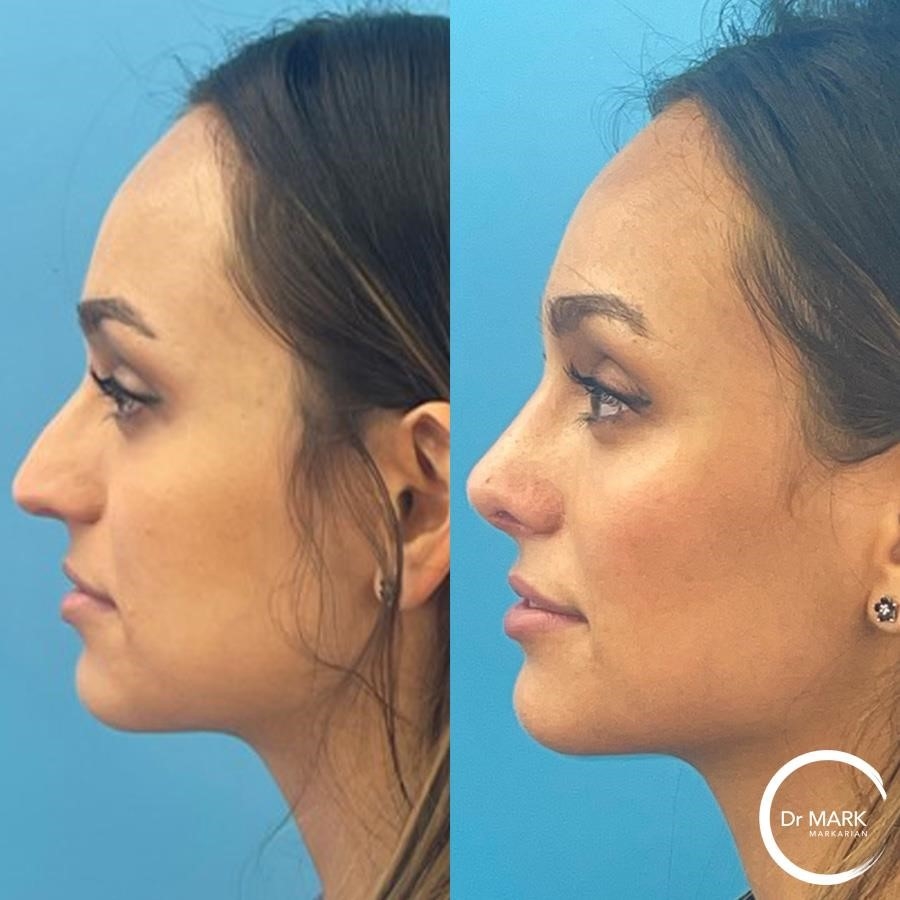 what is a closed rhinoplasty