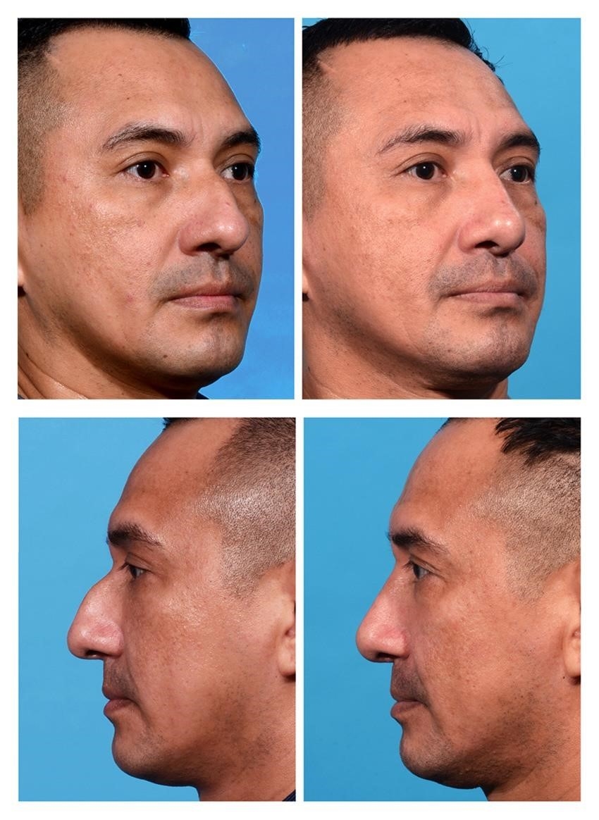 rhinoplasty surgery cost