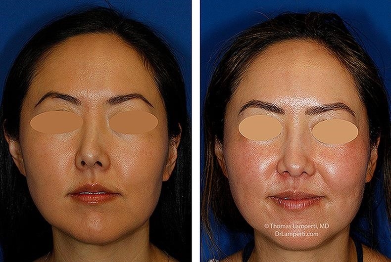 rhinoplasty surgery cost